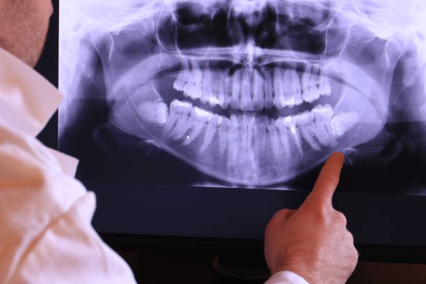 Best Emergency Tooth Extraction in Glasgow, VA